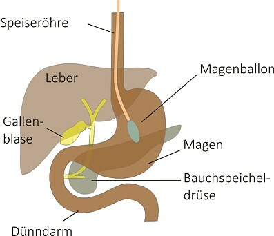 Magenballon1